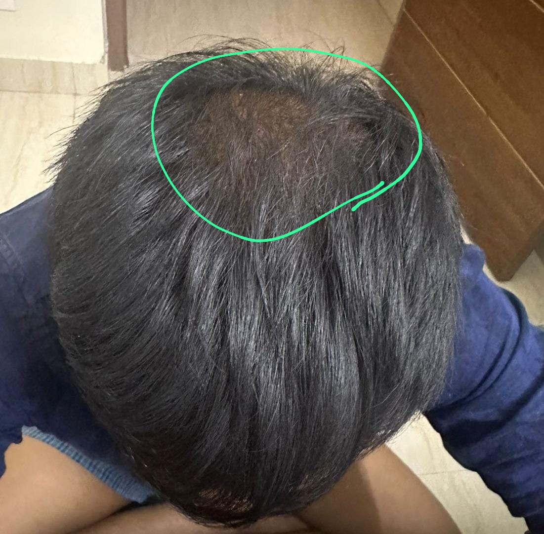 Mr. Naveen - Coimbatore — result after using Vaarshieka