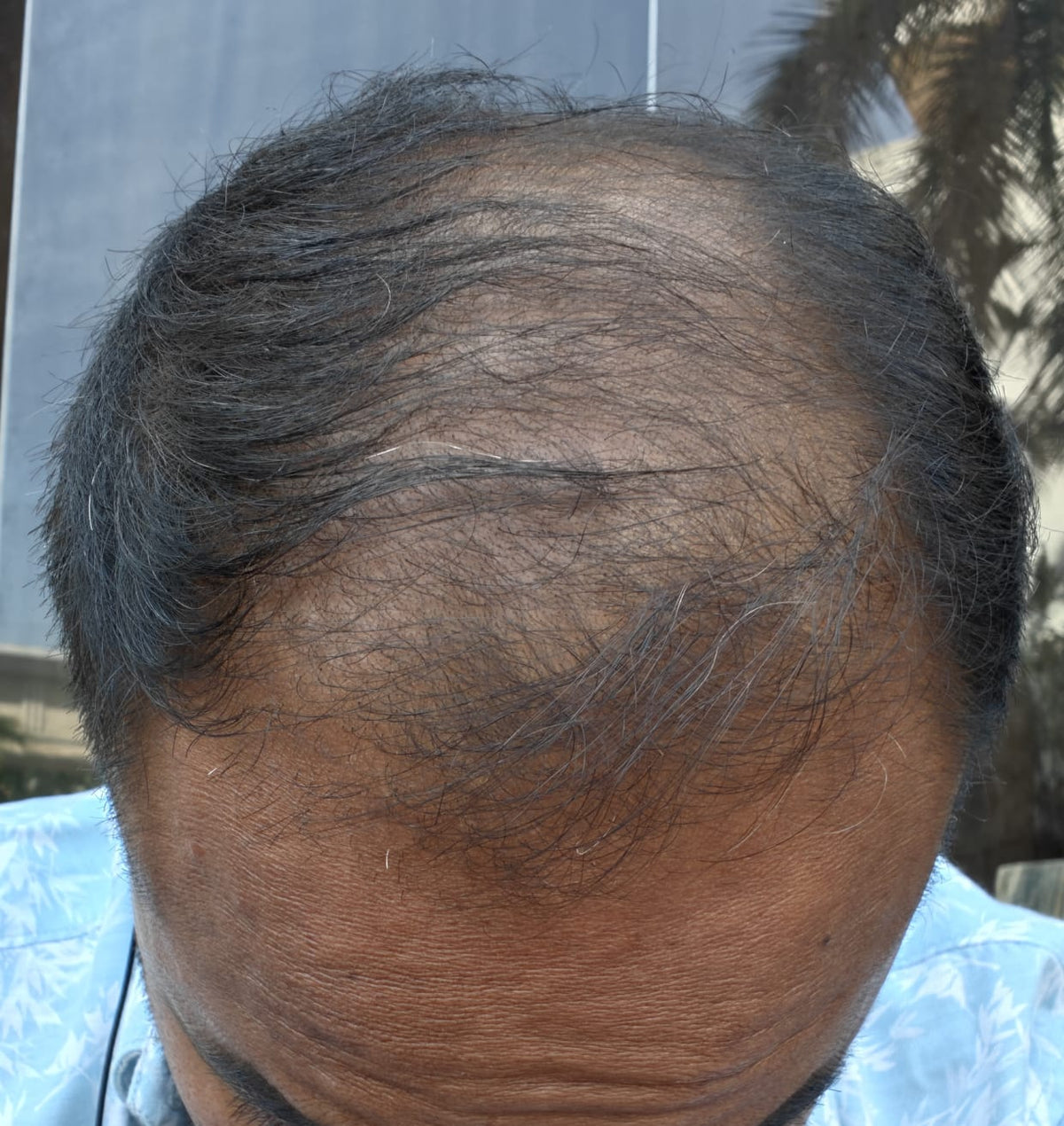 Mr. Bala - Chennai — result after using Vaarshieka