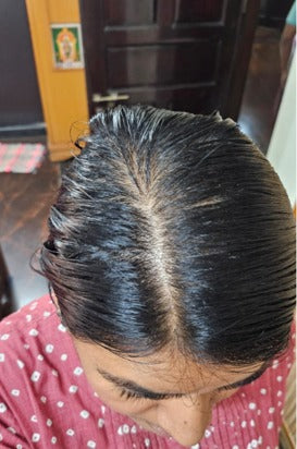 Mrs. Vidya - Bangalore — result after using Vaarshieka