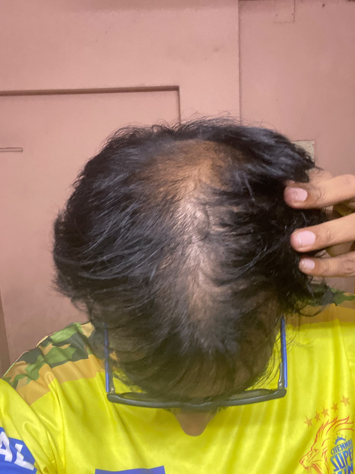 Mr. Anish - Chennai — result after using Vaarshieka