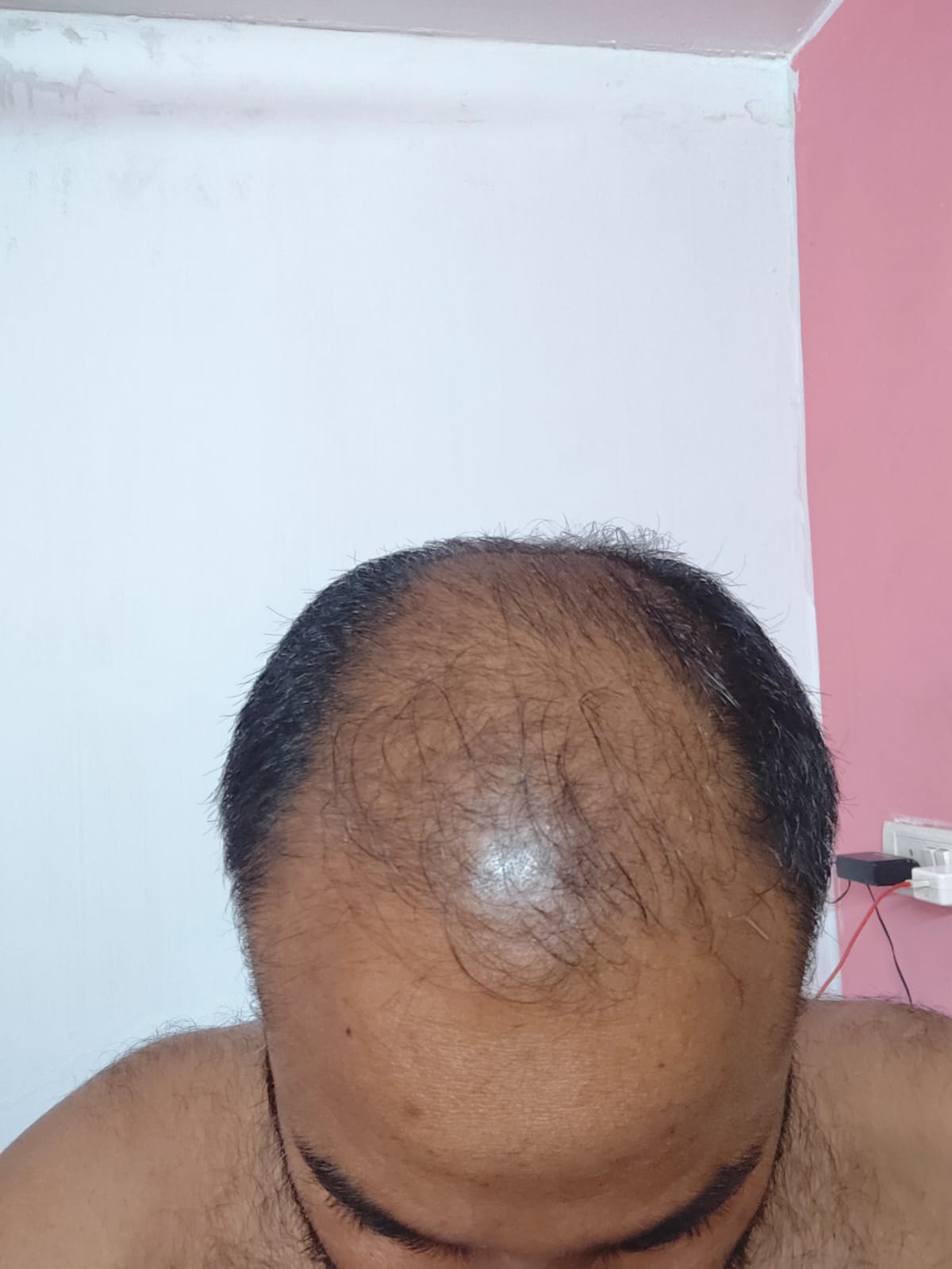 Mr. Bala - Chennai — before using Vaarshieka