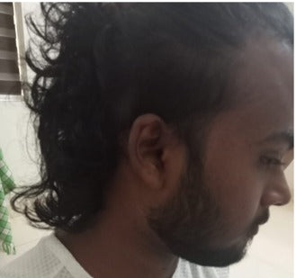 Mr. Akash - Chennai — before using Vaarshieka