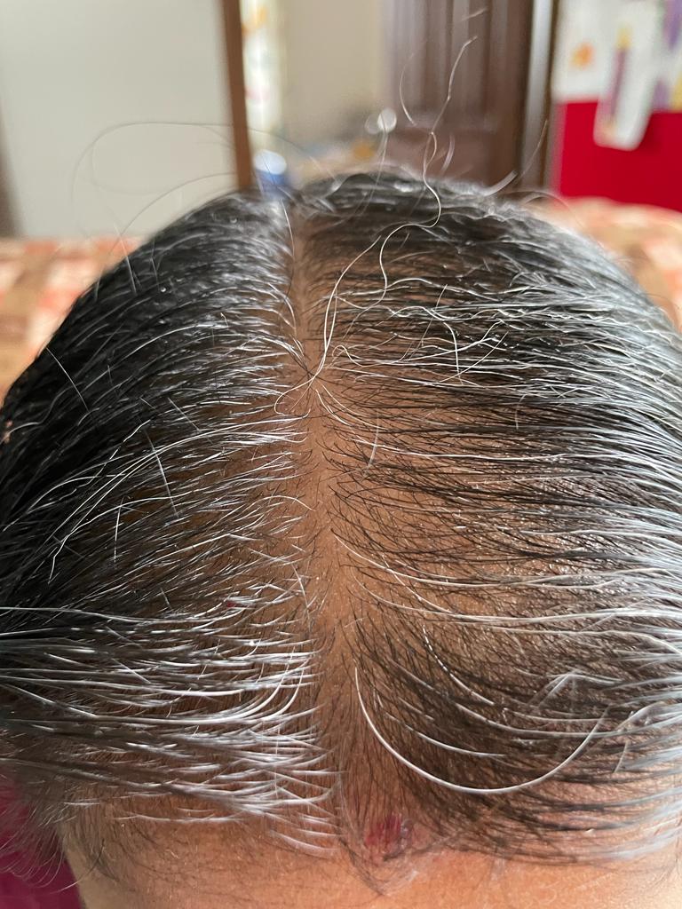 Mrs. Krishna Priya - Bangalore — before using Vaarshieka