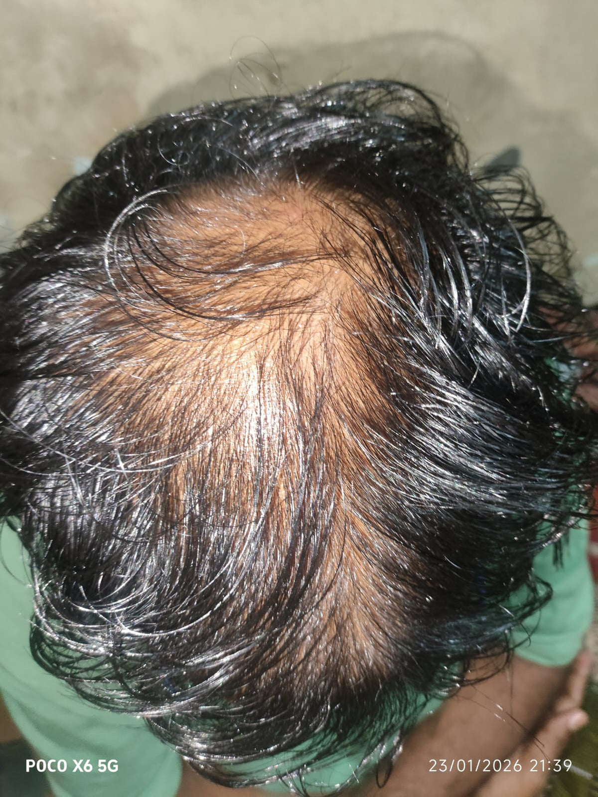 Mr. Anish - Chennai — before using Vaarshieka